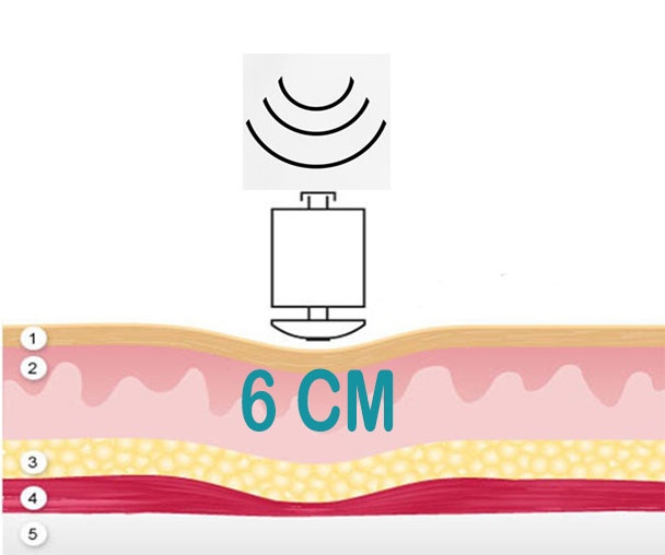 NOVAFON 6CM聲波_