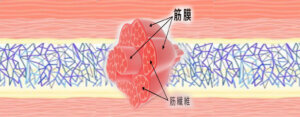 Read more about the article 疼痛來自筋膜卡住缺氧，身體啟動求救訊號”發炎”來修復